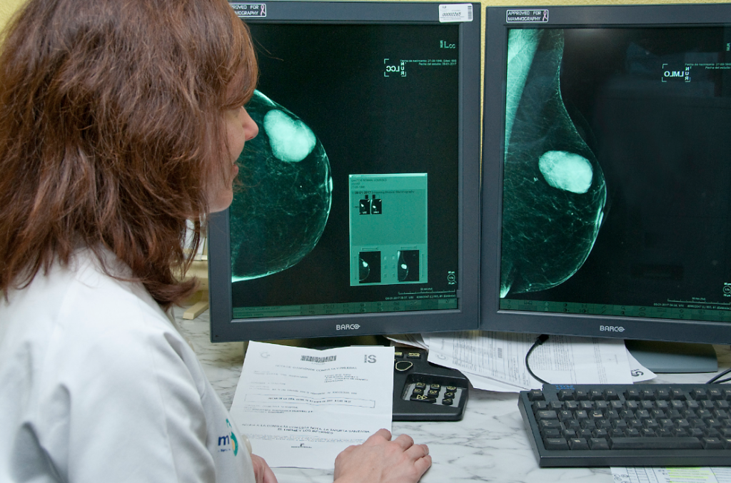 La Sociedad Española de Radiología Médica (SERAM) aconseja rebajar la edad de la primera mamografía preventiva a los 40 años.