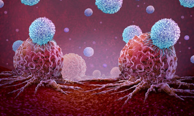 Ya se ha probado en Estados Unidos una nueva inmunoterapia celular que usa linfocitos infiltrantes del tumor frente al cáncer.
